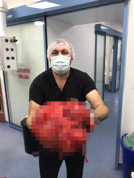 Karın şişliğiyle hastaneye gitti; içinde 14 kilogram kitle çıktı! - 1