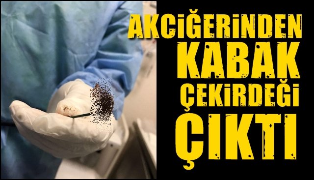 AKCİĞERİNDEN AYLAR ÖNCE YEDİĞİ KABAĞIN ÇEKİRDEĞİ ÇIKTI