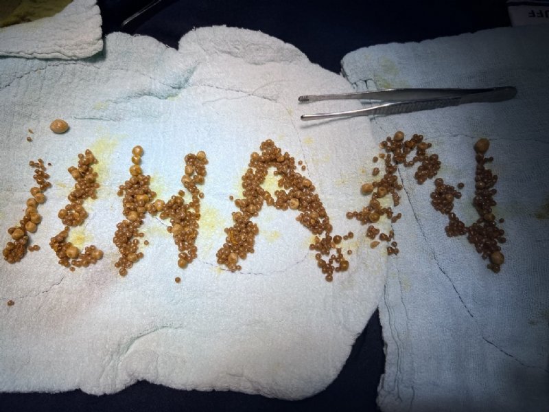 SAFRA KESİNDEN ÇIKAN TAŞ SAYISINI OKUYUNCA İNANAMAYACAKSINIZ! - 2