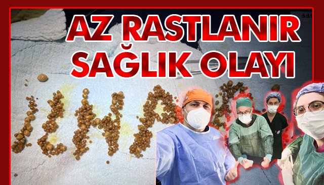 SAFRA KESİNDEN ÇIKAN TAŞ SAYISINI OKUYUNCA İNANAMAYACAKSINIZ!