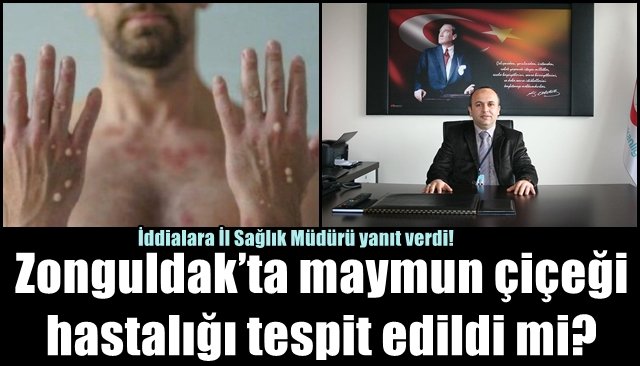 Zonguldak’ta maymun çiçeği hastalığı tespit edildi mi?  İŞTE CEVABI! 