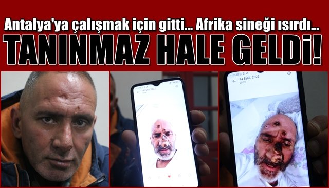 Antalya´ya çalışmak için gitti… Afrika sineği ısırdı… TANINMAZ HALE GELDİ